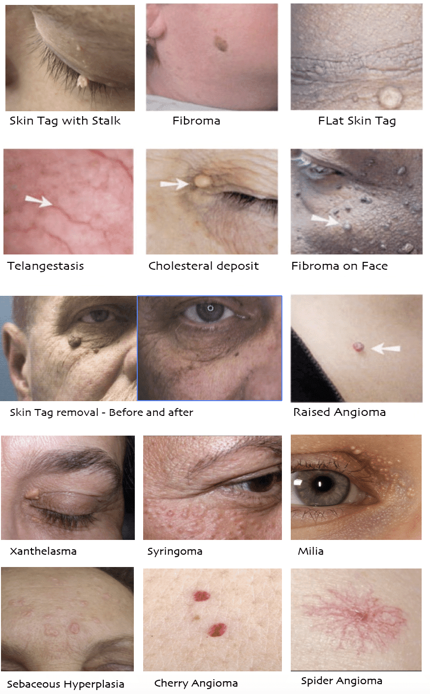 Irregular Skin Minor Skin Irregularities Removal Treatment Sydney